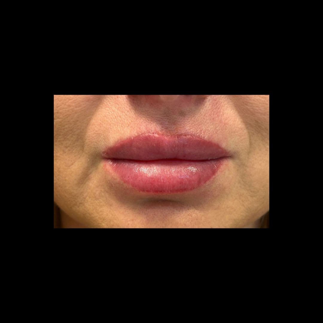 Po zabiegu Lip Lift
