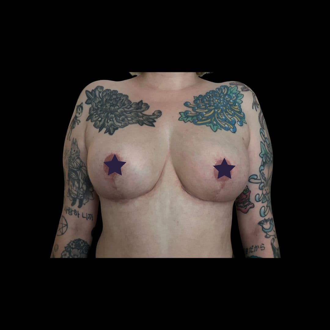 After Breast lift