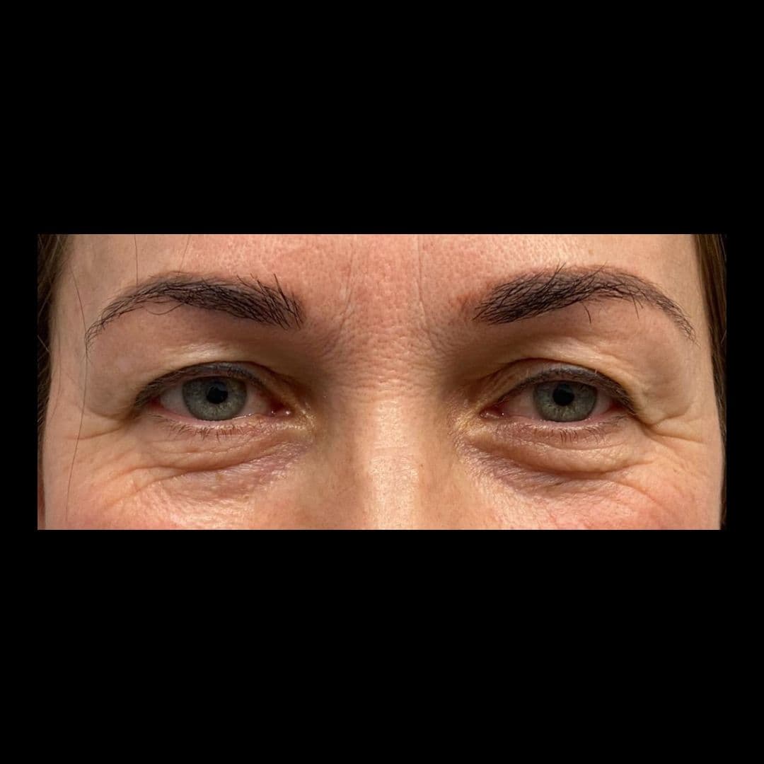 Przed zabiegiem Powieki górne