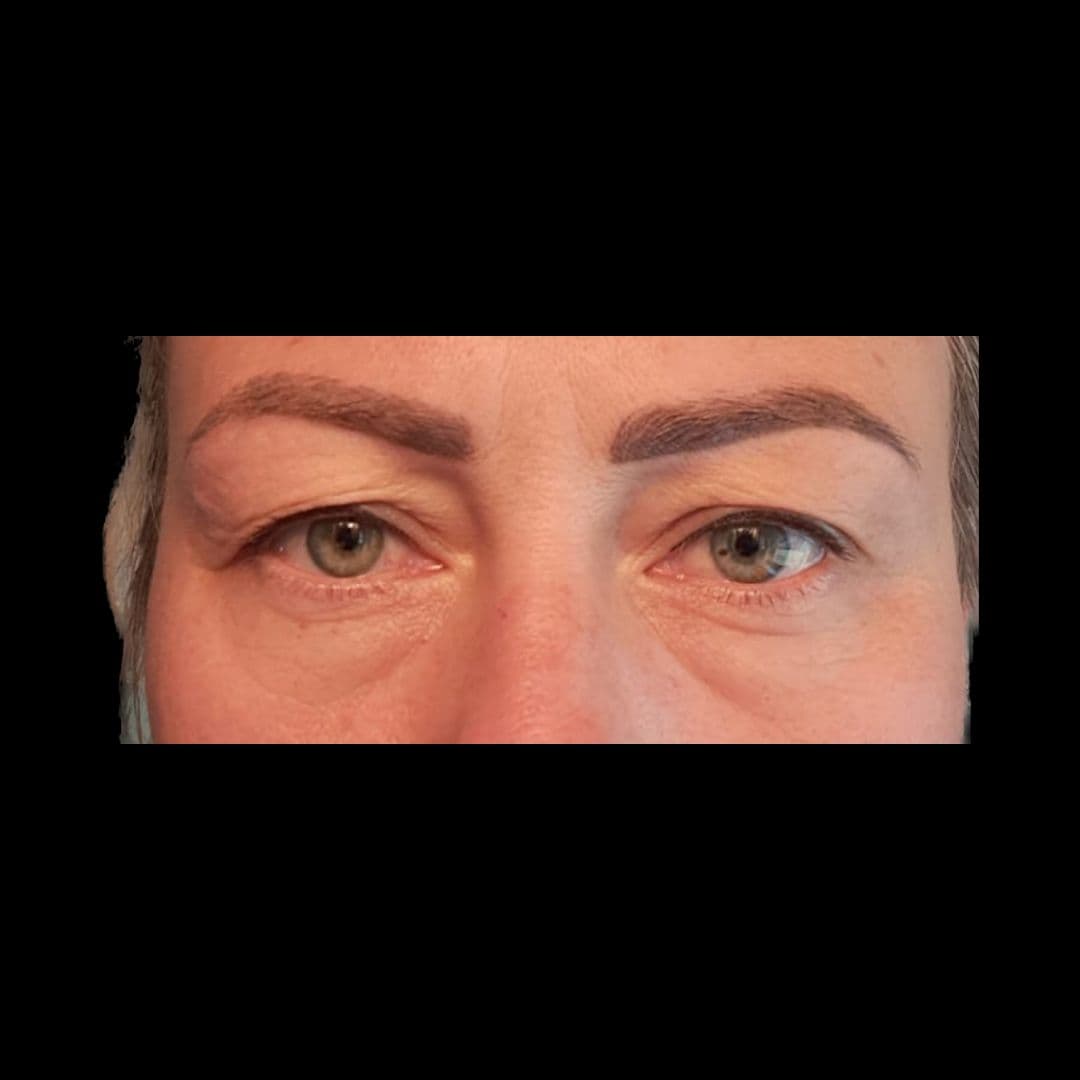 Przed zabiegiem Powieki górne