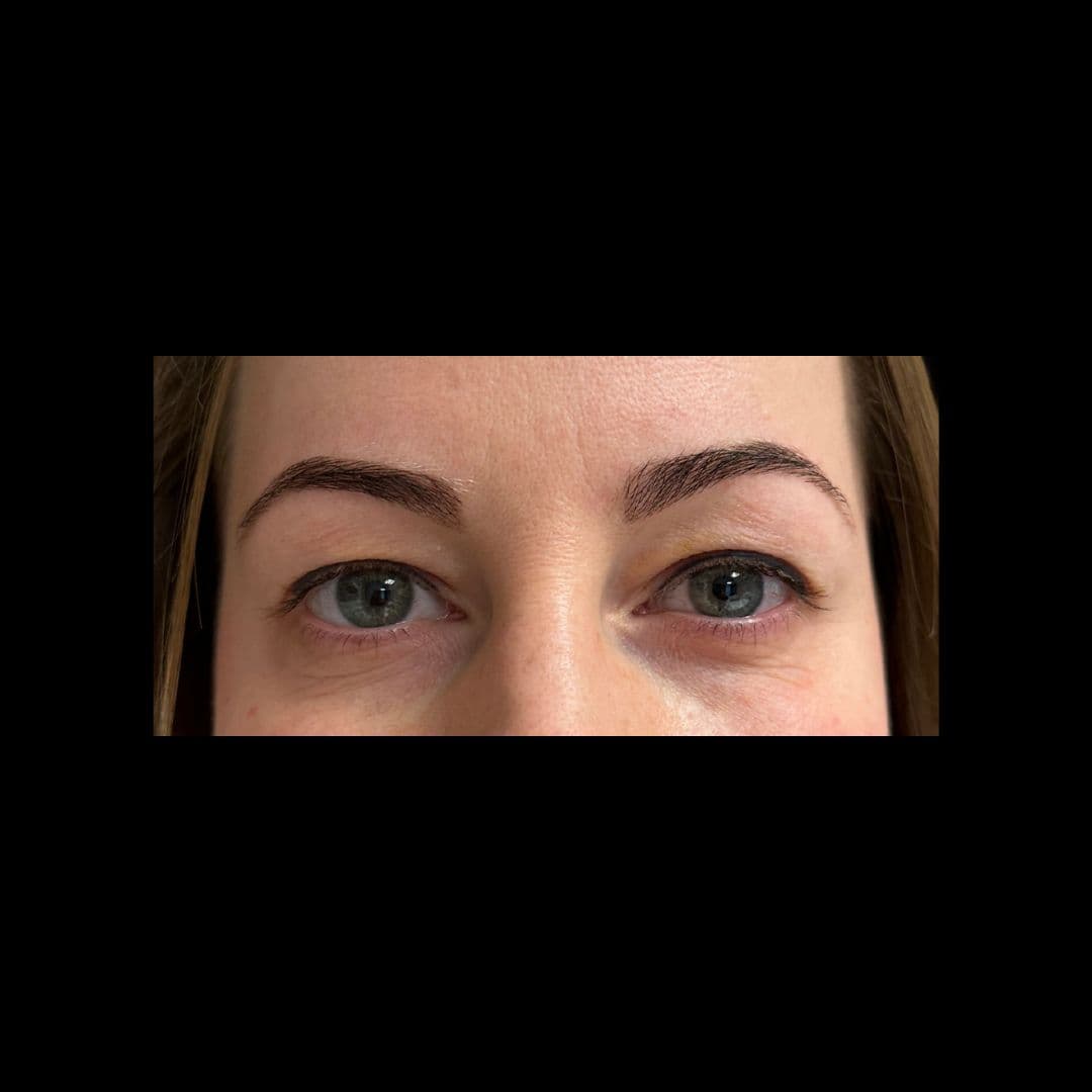 Przed zabiegiem Powieki górne