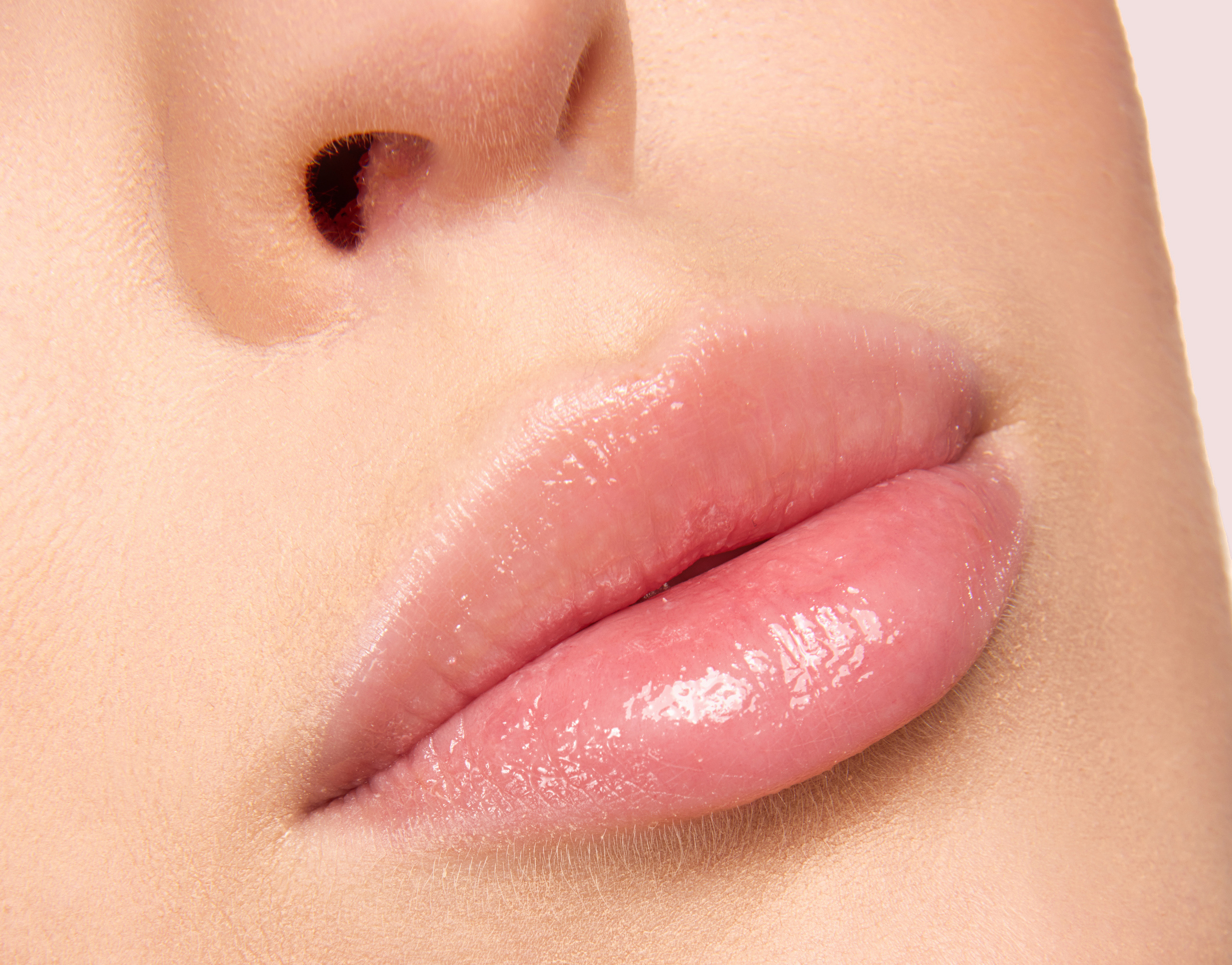 Lip Lift
